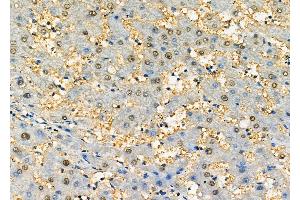 ABIN6256820 and ABIN6277498 at 1/100 staining Human liver cancer by IHC-P.