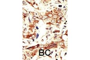 Formalin-fixed and paraffin-embedded human cancer tissue reacted with the primary antibody, which was peroxidase-conjugated to the secondary antibody, followed by AEC staining. (Insulin Receptor antibody  (C-Term))