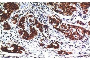 Immunohistochemistry of paraffin-embedded Human breast carcinoma tissue using AKT1 Monoclonal Antibody at dilution of 1:200. (AKT1 antibody)