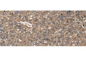 Immunohistochemistry of paraffin-embedded Human liver cancer tissue using CD1B Polyclonal Antibody at dilution of 1:55(x200) (CD1b antibody)