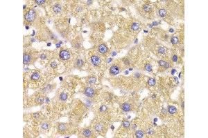 Immunohistochemistry of paraffin-embedded Human liver damage using GPD2 Polyclonal Antibody at dilution of 1:100 (40x lens). (GPD2 antibody)