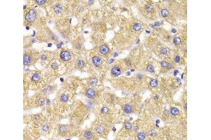 Immunohistochemistry of paraffin-embedded Human liver damage using GPD2 Polyclonal Antibody at dilution of 1:100 (40x lens).