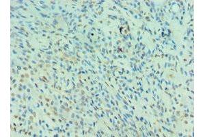 Immunohistochemistry of paraffin-embedded human breast cancer using ABIN7161130 at dilution of 1:100 (NEDD8 antibody  (AA 1-81))