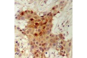 Immunohistochemical analysis of HER2 staining in human breast cancer formalin fixed paraffin embedded tissue section. (ErbB2/Her2 antibody  (C-Term))
