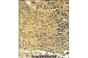 LCLT1 Antibody immunohistochemistry analysis in formalin fixed and paraffin embedded human lung carcinoma followed by peroxidase conjugation of the secondary antibody and DAB staining.