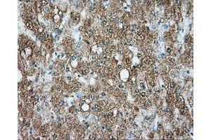 Immunohistochemical staining of paraffin-embedded Carcinoma of liver tissue using anti-SRR mouse monoclonal antibody. (SRR antibody)