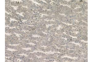 ABIN6256706 and ABIN6267064 at 1/100 staining human renal cell carcinoma by IHC-P. (AKT 1/2/3 antibody  (pTyr312, pTyr315, pTyr316))
