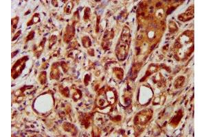 IHC image of ABIN7158186 diluted at 1:400 and staining in paraffin-embedded human pancreatic cancer performed on a Leica BondTM system. (LRRC45 antibody  (AA 222-357))