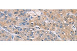 Immunohistochemistry of paraffin-embedded Human liver cancer tissue using ZADH2 Polyclonal Antibody at dilution of 1:100(x200)