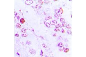 Immunohistochemical analysis of C/EBP beta staining in human lung cancer formalin fixed paraffin embedded tissue section. (CEBPB antibody  (Center))