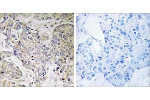 Peptide - +Immunohistochemistry analysis of paraffin-embedded human breast carcinoma tissue using CEP41 antibody.