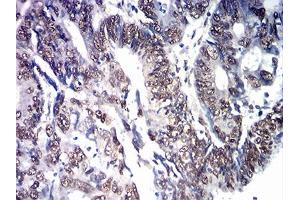 Immunohistochemical analysis of paraffin-embedded cervical cancer tissues using SOX11 mouse mAb with DAB staining.
