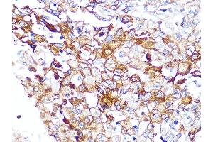 Immunohistochemistry of paraffin-embedded human esophageal cancer using Caveolin-2 Rabbit mAb (ABIN7266155) at dilution of 1:100 (40x lens). (Caveolin 2 antibody)