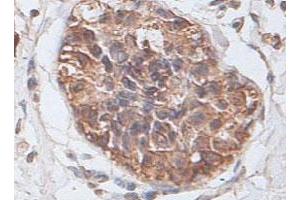 Immunohistochemical staining of formalin-fixed paraffin-embedded human prostate carcinoma tissue showing cytoplasmic and membrane staining with PTP4A2 polyclonal antibody  at 1 : 100 dilution. (PTP4A2 antibody  (AA 2-167))