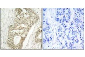 Immunohistochemical analysis of paraffin-embedded human breast carcinoma tissue, using PKC delta (phospho-Ser645) antibody.