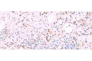 Immunohistochemistry of paraffin-embedded Human cervical cancer tissue using KATNAL1 Polyclonal Antibody at dilution of 1:95(x200)