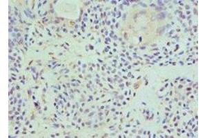 Immunohistochemistry of paraffin-embedded human breast cancer using ABIN7155290 at dilution of 1:100 (HAT1 antibody  (Catalytic Subunit))