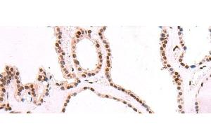 Immunohistochemistry of paraffin-embedded Human thyroid cancer tissue using SF3B3 Polyclonal Antibody at dilution of 1:70(x200) (SF3B3 antibody)