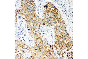 Anti-NOX5 antibody, IHC(P) IHC(P): Human Mammary Cancer Tissue (NOX5 antibody  (C-Term))