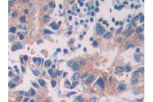 DAB staining on IHC-P; Samples: Human Prostate cancer Tissue (Tyrosine Protein Kinase 7 (AA 853-1070) antibody)