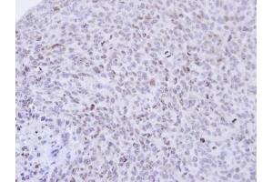 IHC-P Image Immunohistochemical analysis of paraffin-embedded H1299 xenograft , using PCNP, antibody at 1:500 dilution. (PCNP antibody  (N-Term))