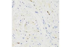 Immunohistochemistry of paraffin-embedded human breast cancer using GEMIN2 Antibody (ABIN5971577) at dilution of 1/100 (40x lens). (SIP1 antibody)