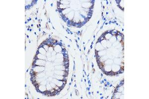 Immunohistochemistry of paraffin-embedded human colon carcinoma using TRIM16 antibody (ABIN7270978) at dilution of 1:100 (40x lens).