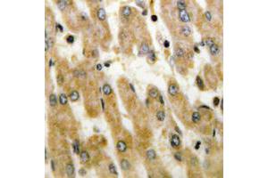 Immunohistochemical analysis of DUSP1/4 staining in human liver cancer formalin fixed paraffin embedded tissue section. (MKP-1/2 antibody  (C-Term))