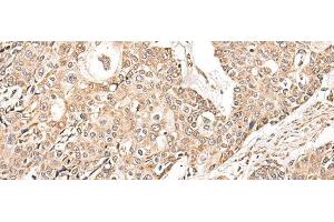Immunohistochemistry of paraffin-embedded Human prost ate cancer tissue using NDUFB11 Polyclonal Antibody at dilution of 1:95(x200) (NDUFB11 antibody)
