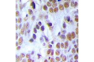 Immunohistochemical analysis of MCM3 staining in human breast cancer formalin fixed paraffin embedded tissue section. (MCM3 antibody)