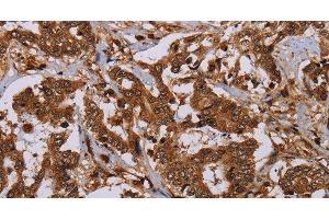 Immunohistochemistry of paraffin-embedded Human liver cancer using MOB1A Polyclonal Antibody at dilution of 1:30 (MOB1A antibody)