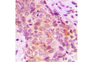 Immunohistochemical analysis of MARK3 staining in human breast cancer formalin fixed paraffin embedded tissue section. (MARK3 antibody  (N-Term))