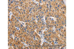Immunohistochemistry of Human colon cancer using APLNR Polyclonal Antibody at dilution of 1:40