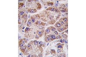 Formalin-fixed and paraffin-embedded human hepatocarcinoma tissue reacted with FDPS antibody (Center ) (ABIN389054 and ABIN2839263) , which was peroxidase-conjugated to the secondary antibody, followed by DAB staining. (FDPS antibody  (AA 389-419))