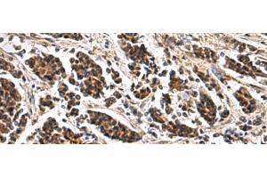 Immunohistochemistry of paraffin-embedded Human breast cancer tissue using ARPC1B Polyclonal Antibody at dilution of 1:65(x200) (ARPC1B antibody)