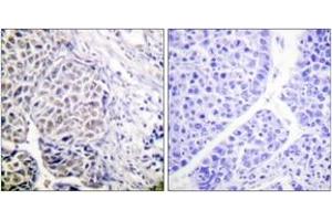 Immunohistochemistry analysis of paraffin-embedded human liver carcinoma, using AurB (Phospho-Tyr12) Antibody. (Aurora Kinase B antibody  (pTyr12))