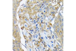 Immunohistochemistry of paraffin-embedded human lung cancer using R Rabbit mAb (ABIN7269840) at dilution of 1:100 (40x lens). (RALBP1 antibody)
