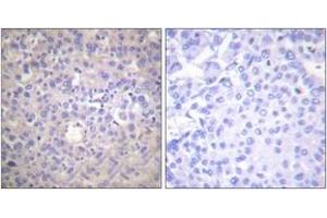 Immunohistochemistry analysis of paraffin-embedded human breast carcinoma, using IRS-1 (Phospho-Ser612) Antibody. (IRS1 antibody  (pSer616))