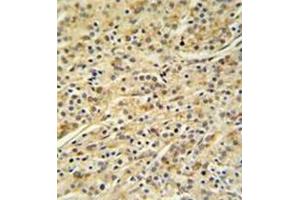 Immunohistochemistry analysis in formalin fixed and paraffin embedded prostate carcinoma reacted with HOXA3 / HOX1E Antibody (C-term) Cat.