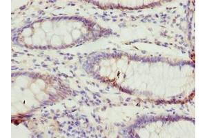 Immunohistochemistry of paraffin-embedded human colon cancer using ABIN7171939 at dilution of 1:100 (TTC38 antibody  (AA 2-200))