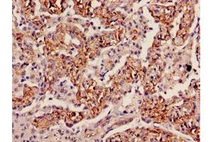 Immunohistochemistry of paraffin-embedded human lung cancer using ABIN7156215 at dilution of 1:100 (INMT antibody  (AA 1-263))
