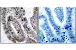 Immunohistochemical analysis of paraffin-embedded human colon carcinoma tissue using AMPKa1(Phospho-Ser487)Antibody(left) or the same antibody preincubated with blocking peptide(right). (AMPK alpha antibody  (pSer487))