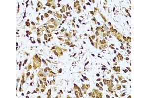 Immunohistochemistry of paraffin-embedded Human gastric cancer using KU70 Polyclonal Antibody at dilution of 1:100 (40x lens). (XRCC6 antibody)