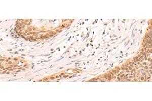 Immunohistochemistry of paraffin-embedded Human esophagus cancer tissue using SIX6 Polyclonal Antibody at dilution of 1:30(x200) (SIX Homeobox 6 antibody)