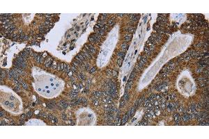 Immunohistochemistry of paraffin-embedded Human colon cancer using GOT2 Polyclonal Antibody at dilution of 1:50 (GOT2 antibody)