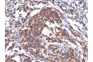Formalin-fixed, paraffin-embedded human Melanoma stained with Vimentin Monoclonal Antibody (LN-6). (Vimentin antibody)