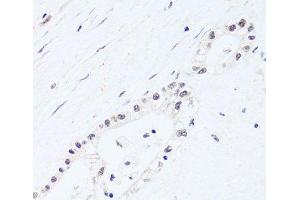 Immunohistochemistry of paraffin-embedded Human gastric cancer using BRIX1 Polyclonal Antibody at dilution of 1:100 (40x lens). (BRIX1 antibody)