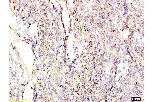 Formalin-fixed and paraffin embedded human cervical carcinoma labeled with Anti-CGA/ Chromogranin A Polyclonal Antibody, Unconjugated (ABIN669846) at 1:200 followed by conjugation to the secondary antibody and DAB staining