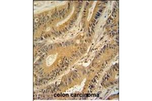 GNAT3 antibody (Center) (ABIN654441 and ABIN2844175) immunohistochemistry analysis in formalin fixed and paraffin embedded human colon carcinoma followed by peroxidase conjugation of the secondary antibody and DAB staining. (GNAT3 antibody  (AA 78-105))