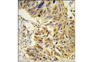 Immunohistochemistry analysis in Formalin Fixed, Paraffin Embedded lung carcinoma stained with SDR Antibody (Center) followed by peroxidase conjugation of the secondary antibody and DAB staining.